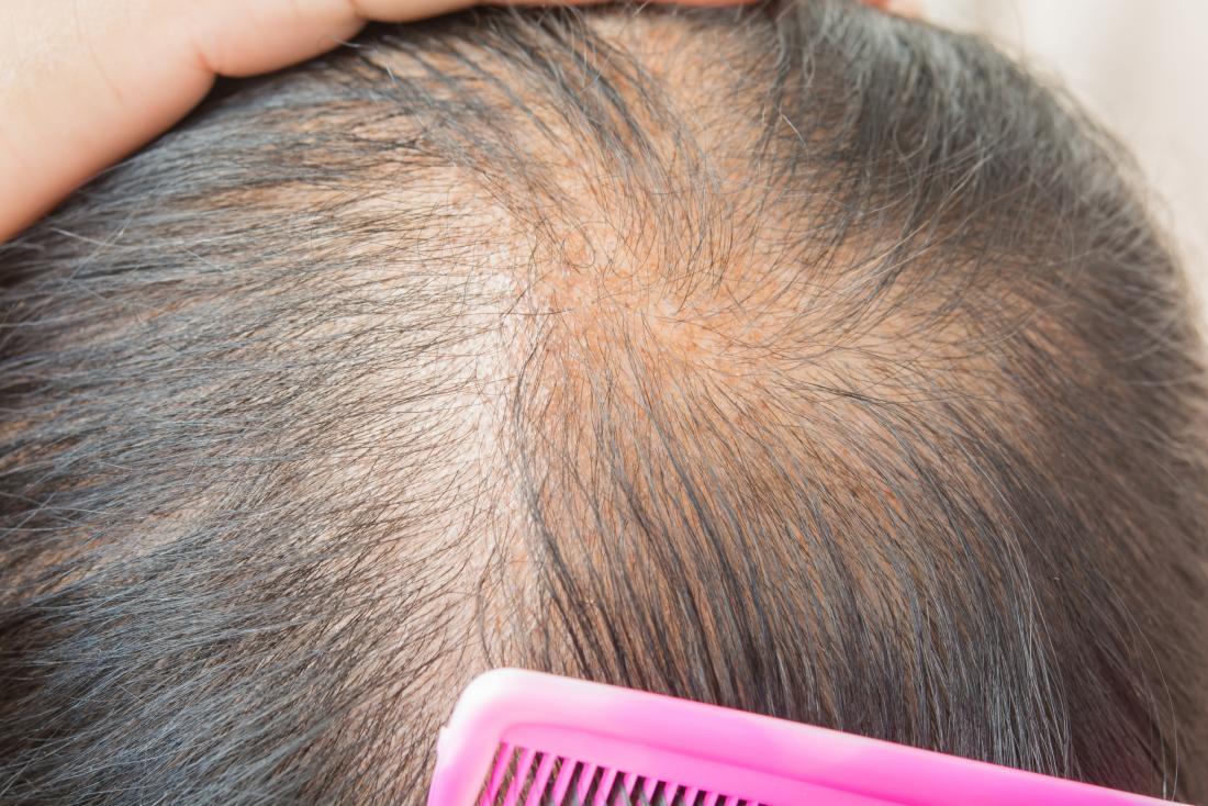 Find the Best Hair Regrowth Treatment to Get Back Hair on Your Head